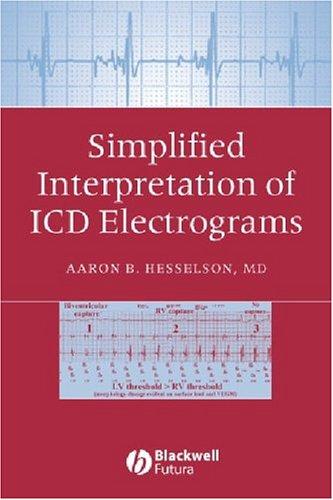 Simplified interpretation of ICD electrograms