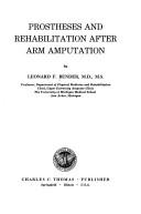 Prostheses and rehabilitation after arm amputation