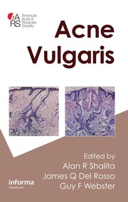 Acne vulgaris